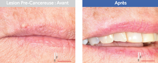 Paro Plateau Clinique de parodontie et d'implantologie du Plateau Montreal Clinique Dentaire Dentistes