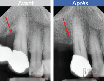 Paro Plateau Clinique de parodontie et d'implantologie du Plateau Montreal Clinique Dentaire Dentistes